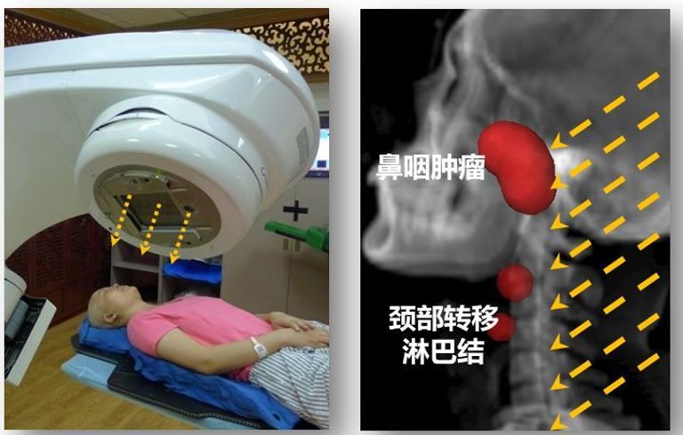 أداة جديدة تتفوق على البشر في تحديد أورام الرأس والعنق