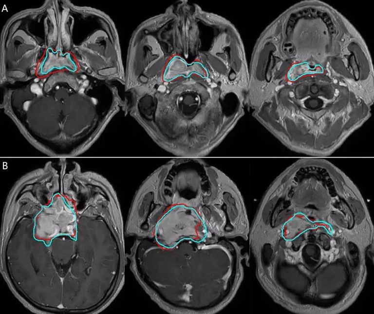 أداة جديدة تتفوق على البشر في تحديد أورام الرأس والعنق