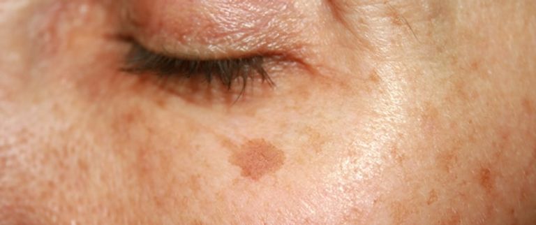 انخفاض ضغط الدم والشعور بالدوخة من أعراض الحمل الطبيعية