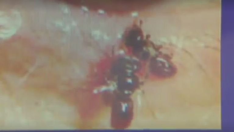 استخراج 4 نحلات من عين امرأة