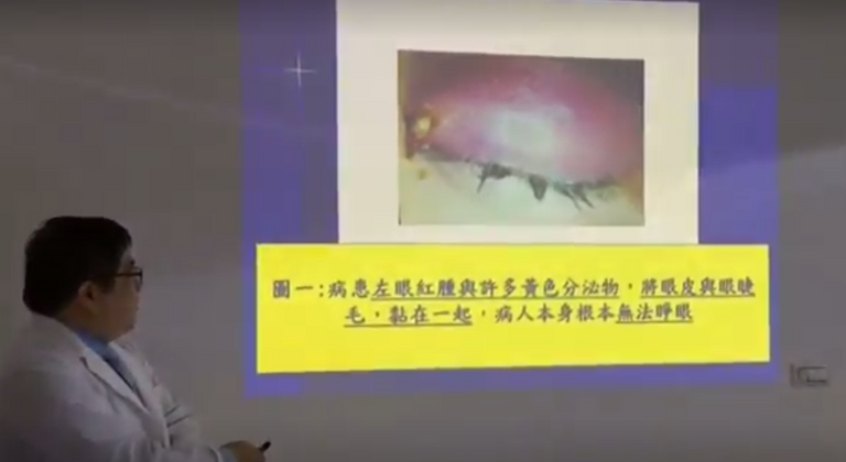 استخراج 4 نحلات من عين امرأة