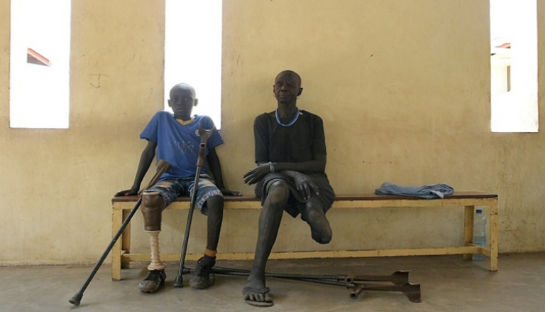 مبتورو أطراف في جنوب السودان يعانون للحصول على أعضاء اصطناعية