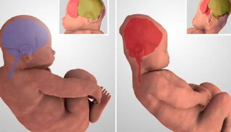 مراحل تغير شكل رأس المولود
