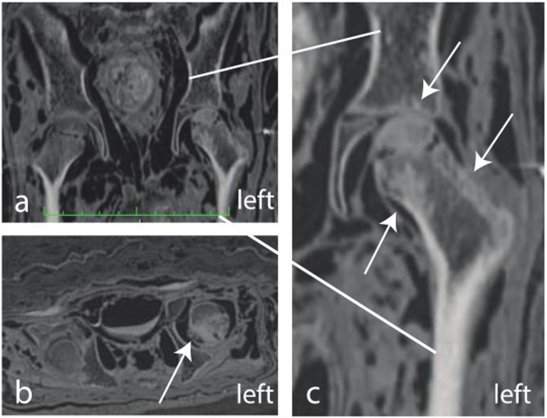 الأشعة أظهرت نخر واضحة في عظام المومياء