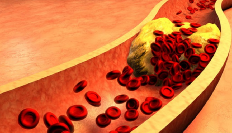 المستويات المرتفعة من الكوليسترول في الدم لها آثار صحية ضارة - تعبيرية