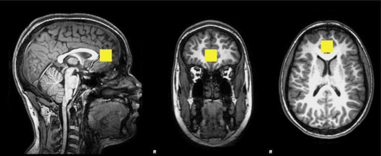 صورة توضح تأثير التلوث على المخ 