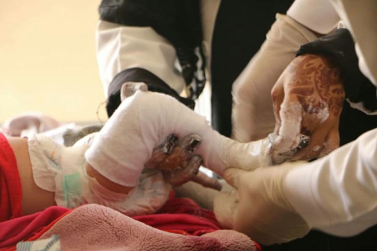 أحد الأطفال مبتورو الأطراف إثر الألغام الحوثية في تعز