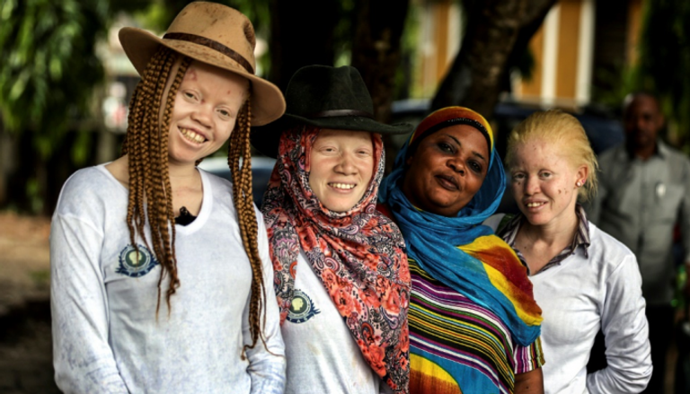 يعاني كل المصابين بالمهق تقريبًا من ضعف البصر