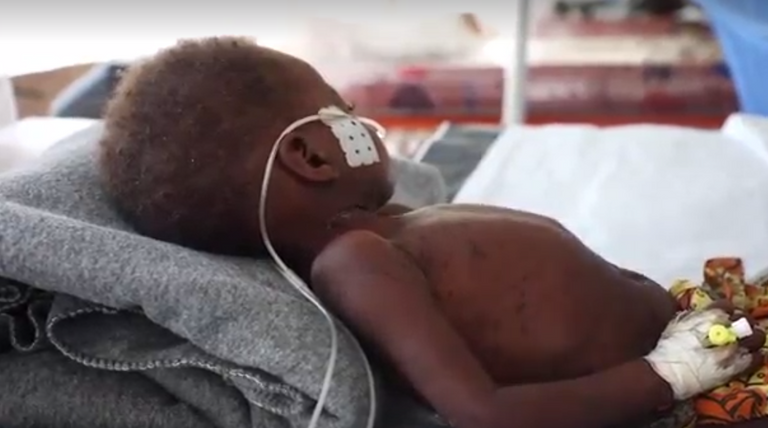 الحصبة تهدّد حياة الأطفال في الكونجو الديمقراطية