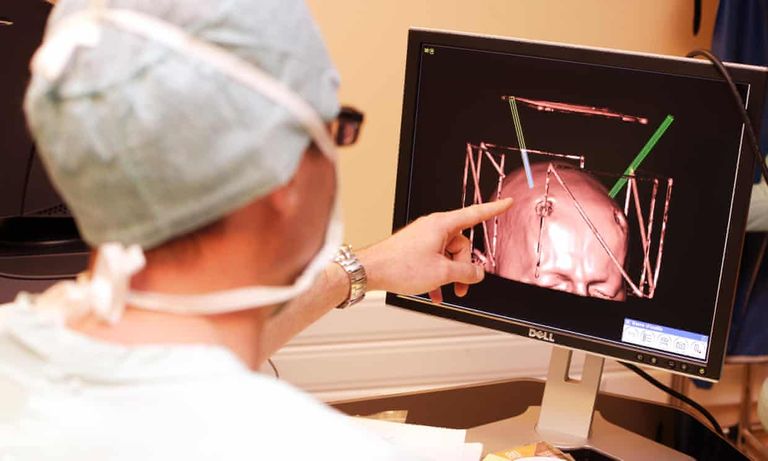 تغيرات بالدماغ تكون بمثابة علامات تحذيرية من مرض الشلل الرعاش