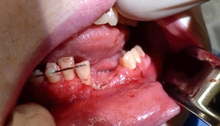 حالة الصبي بعد انفجار السيجارة