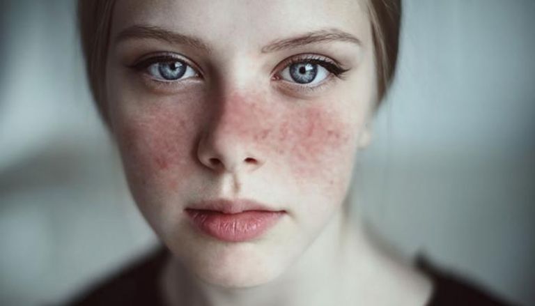 مرض الذئبة الحمراء قد يظهر على الجلد في شكل طفح جلدي 