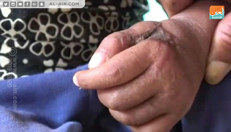 ألغام الحوثي تحصد أرواح المدنيين في قرية المسنا قرية المسنا بمحافظة الحديدة تعاني من جرائم الحوثي ضد الإنسانية