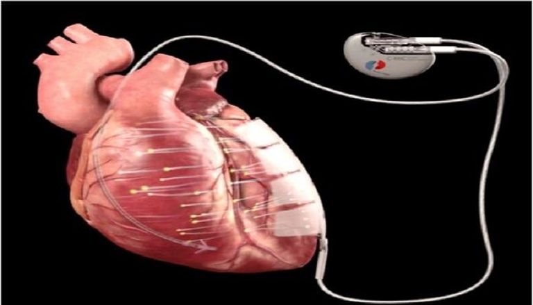 الجهاز الصغير يصدر تيارا كهربائيا يؤدي إلى تحفيز عضلة القلب