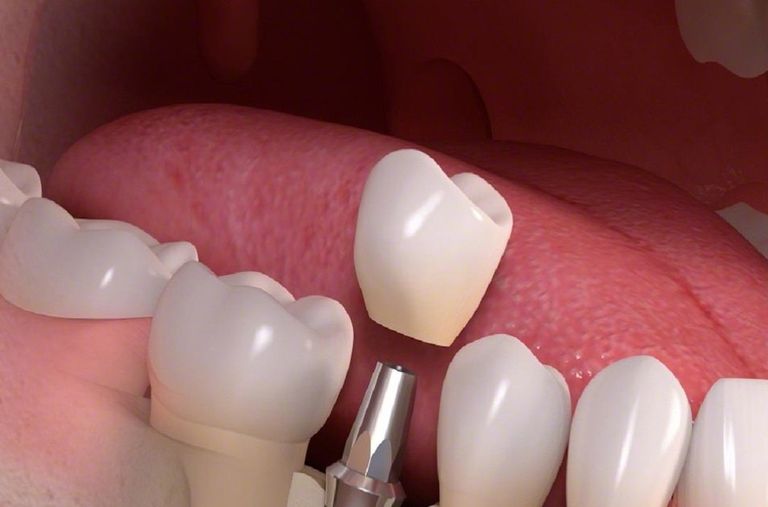 عملية زراعة الأسنان تناسب المصابين بالأمراض المزمنة - أرشيفية