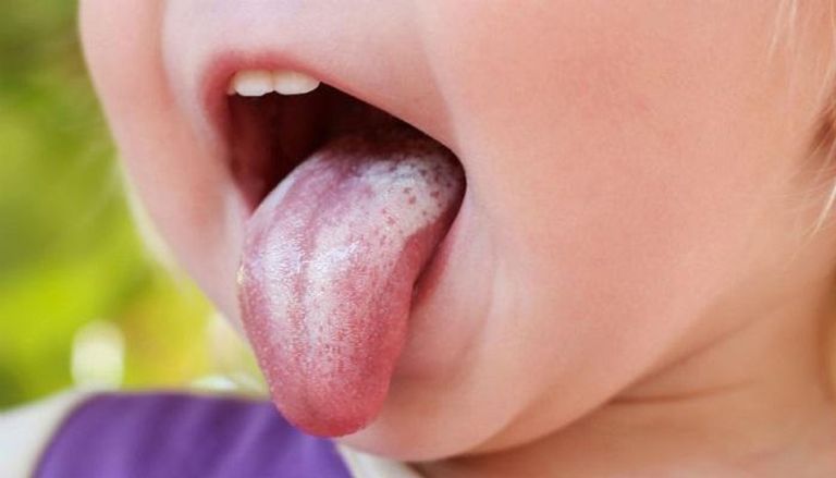 فطريات الفم من الأمراض المؤلمة للأطفال
