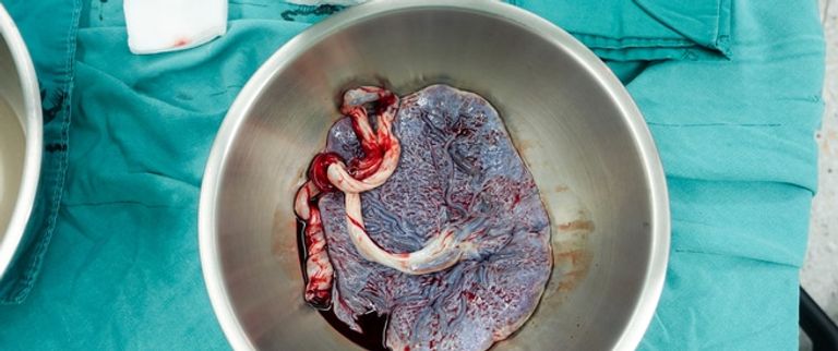 3 جراحين مصريين في مواجهة مع المشيمة المتقدمة والملتصقة- أرشيفية