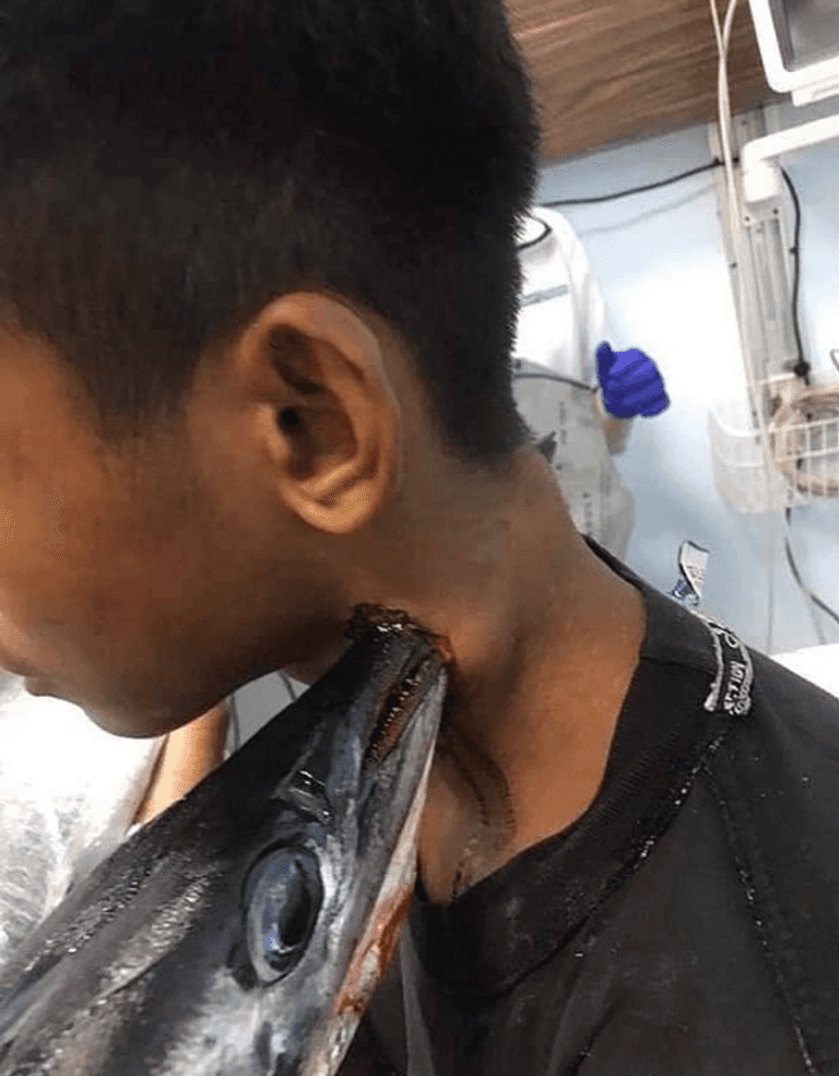 سمكة إبرة تخترق عنق إندونيسي