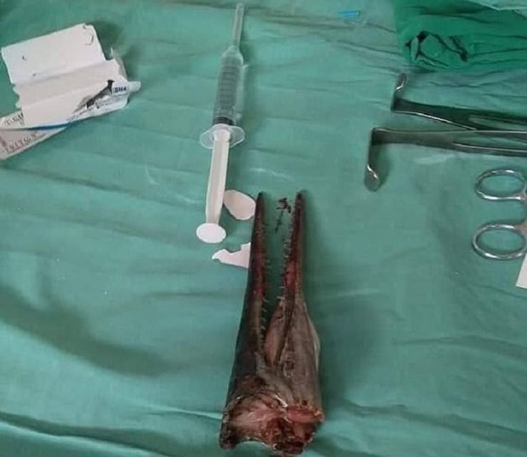 سمكة إبرة تخترق عنق إندونيسي