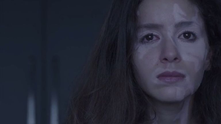 مريضة بالبهاق - تعبيرية