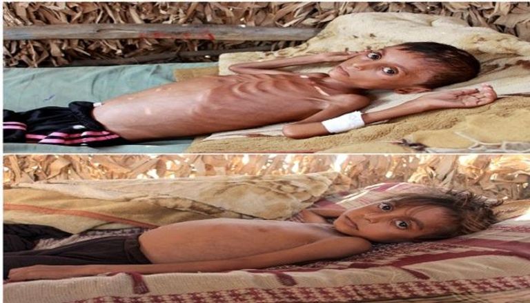 صورة توضح تدهور صحة الطفل اليمني حسن مرزام محمد خلال4 أشهر- رويترز