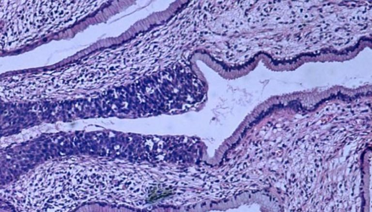 صورة مجهرية لسرطان عنق الرحم 