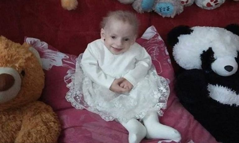 آنا توفيت بمرض وراثي نادر للغاية