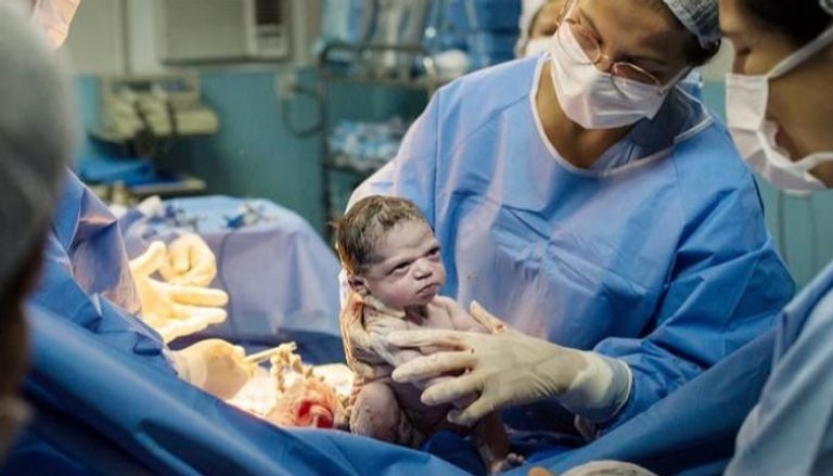مولودة برازيلية تنظر بغضب للطبيب بعد وصولها للدنيا - ميرور
