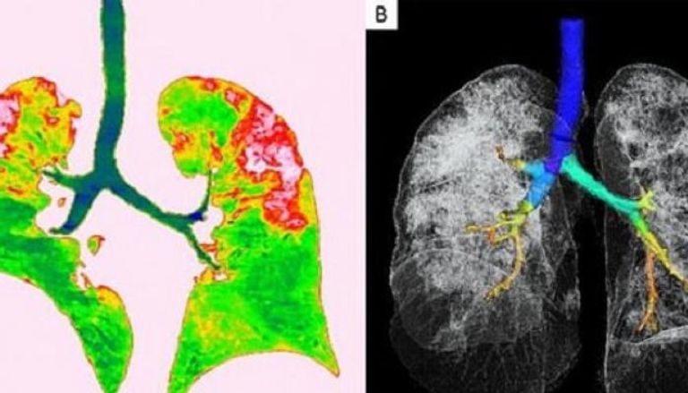 صور أشعة توضح ما يحدث للرئة عند الإصابة بفيروس كورونا
