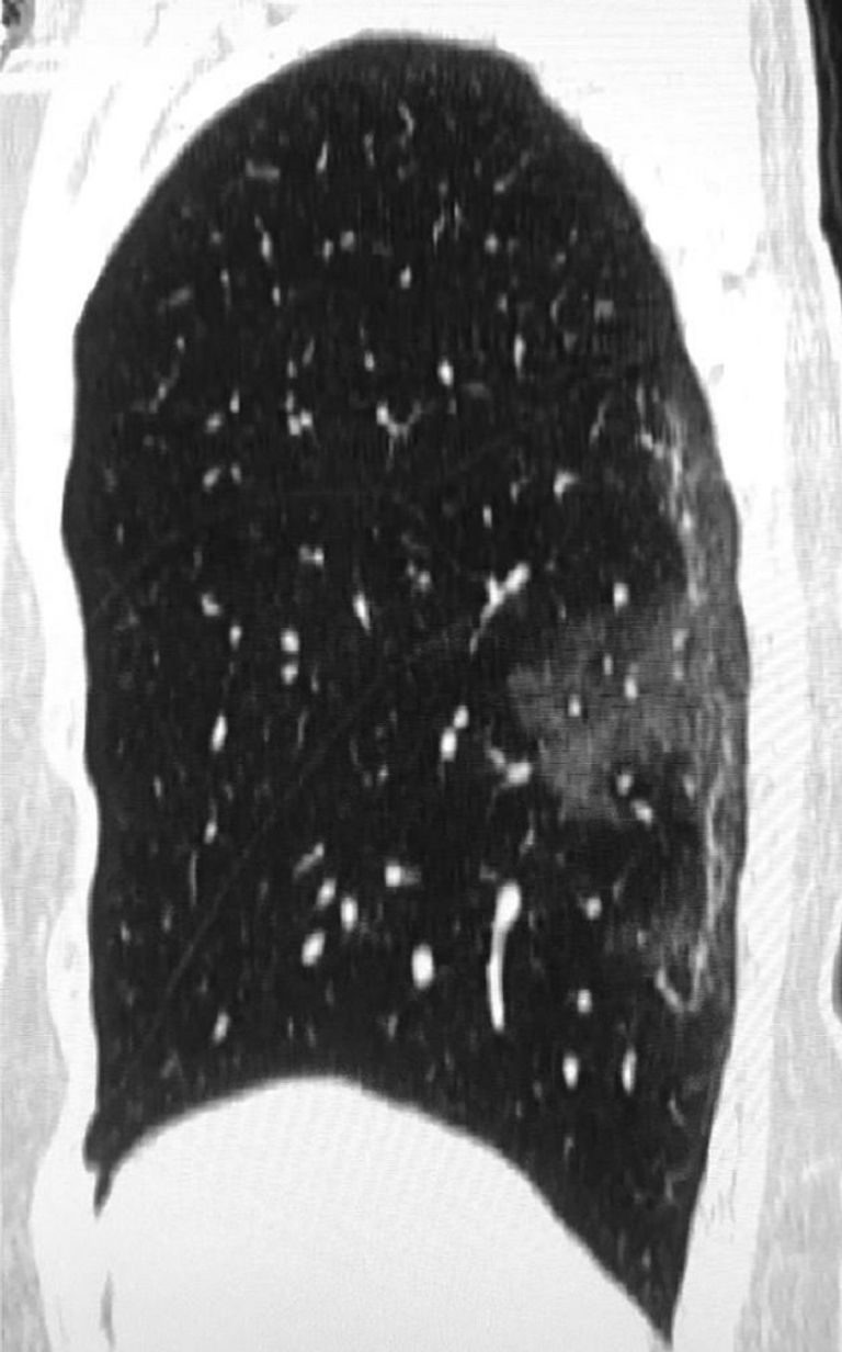 صور توضح ما يفعله فيروس كورونا في الرئة صور أشعة توضح ما يحدث للرئة عند الإصابة بفيروس كورونا