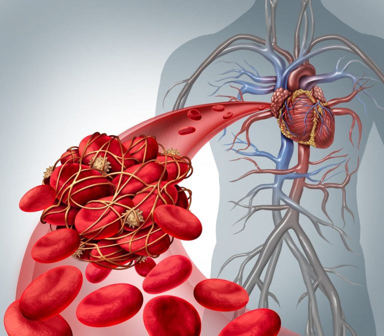 ما هي الجلطات الدموية وأنواعها وأسبابها وكيفية العلاج؟