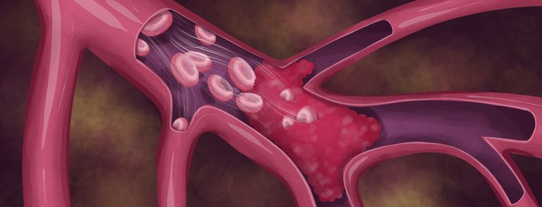 علاج الجلطات الدموية ماهي الجلطات الدموية وأنواعها وأسبابها وكيفية العلاج؟