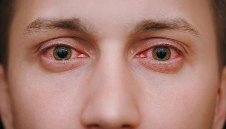 احمرار العين من أعراض التهاب الملتحمة التحسسي 