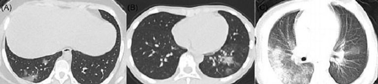 كورونا ينشر الالتهابات في رئة الأطفال