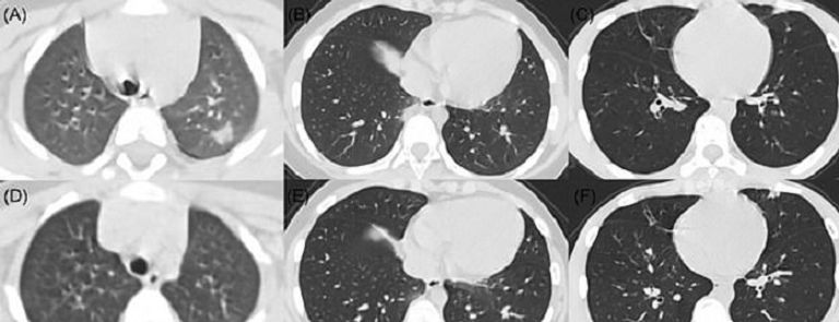كورونا ينشر الالتهابات في رئة الأطفال