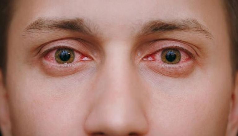 مخاوف بشأن تأثر البصر والعينين بسبب كورونا