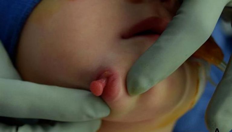 الطفلة أثناء تجهيزها للعمل لاستئصال الفم الثاني