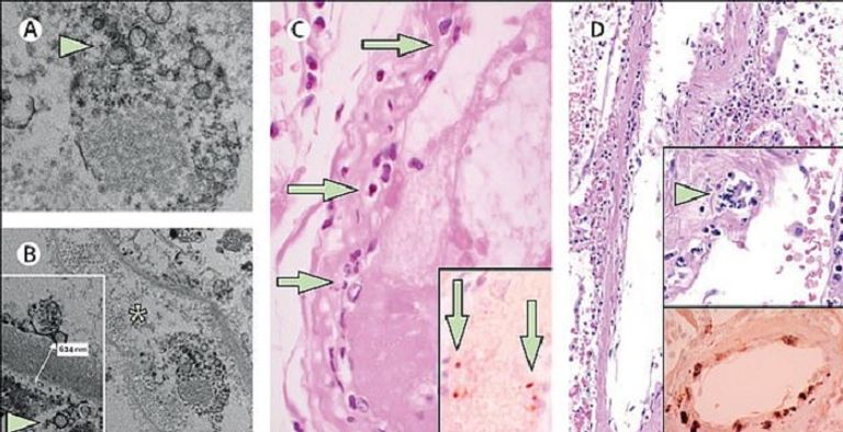 مريضة موضوعة على جهاز للتنفس الاصطناعي - أرشيفية