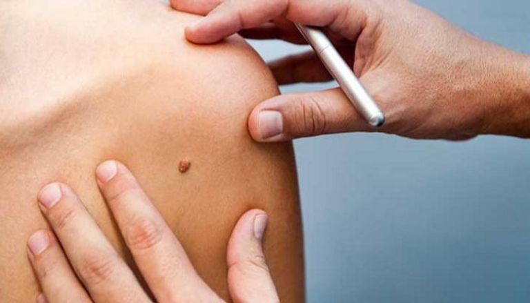 اللاصقة الطبية تعالج سرطان الجلد بدون ألم