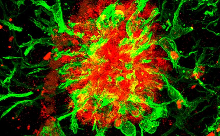 "التلفيف المسنن" يتلف لدى المصابين بمرض ألزهايمر