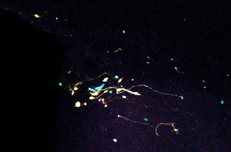 "التلفيف المسنن" يتلف لدى المصابين بمرض ألزهايمر