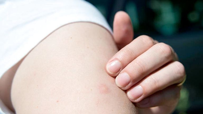  6 أمراض تنقلها لدغات البعوض