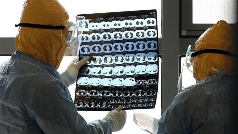 فيروس كورونا المستجد يمكن أن يصيب الدماغ بتلف