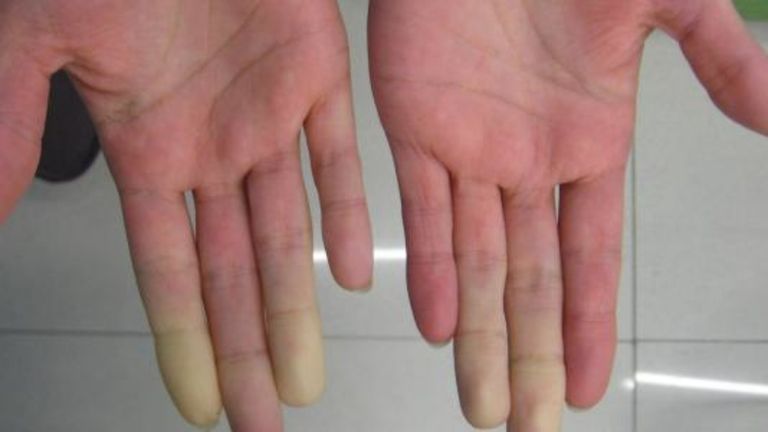 طرق علاج متلازمة رينود الشعور بالتنميل أحد أعراض متلازمة رينود