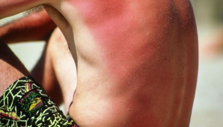 أي التهاب يصيب البشرة بسبب أشعة الشمس يزيد خطر الإصابة بسرطان الجلد