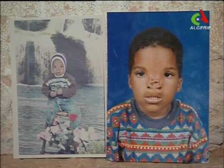 أحد الأطفال الجزائريين المشوهين من التجارب النووية الفرنسية جنوب البلاد