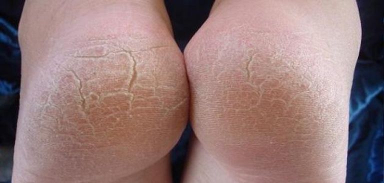 يرجع سبب تشقق الكعبين إلى افتقار الجسم لعناصر غذائية مهمة