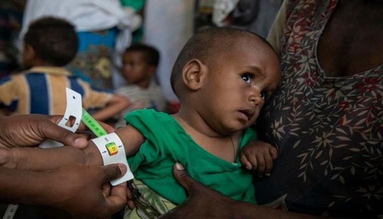 طفل يعاني من سوء التغذية في تيجراي