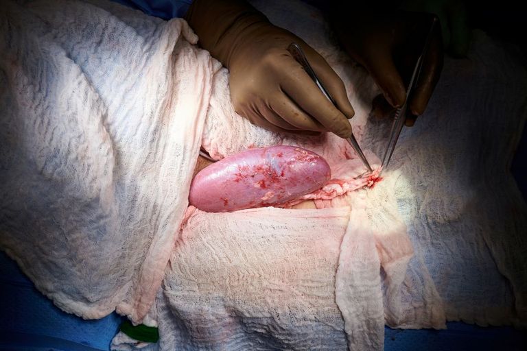 تم ربط الكلية الجديدة بالأوعية الدموية للمريضة والحفاظ عليها خارج جسدها