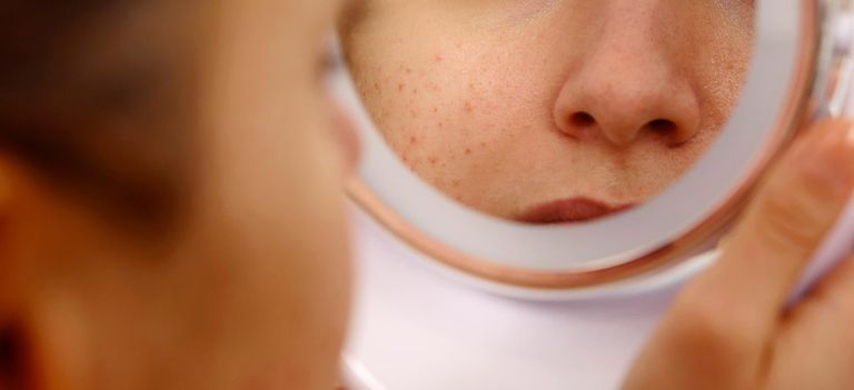 مرضى الذئبة لديهم نوع غير معروف من جزيئات البروتين في الدم